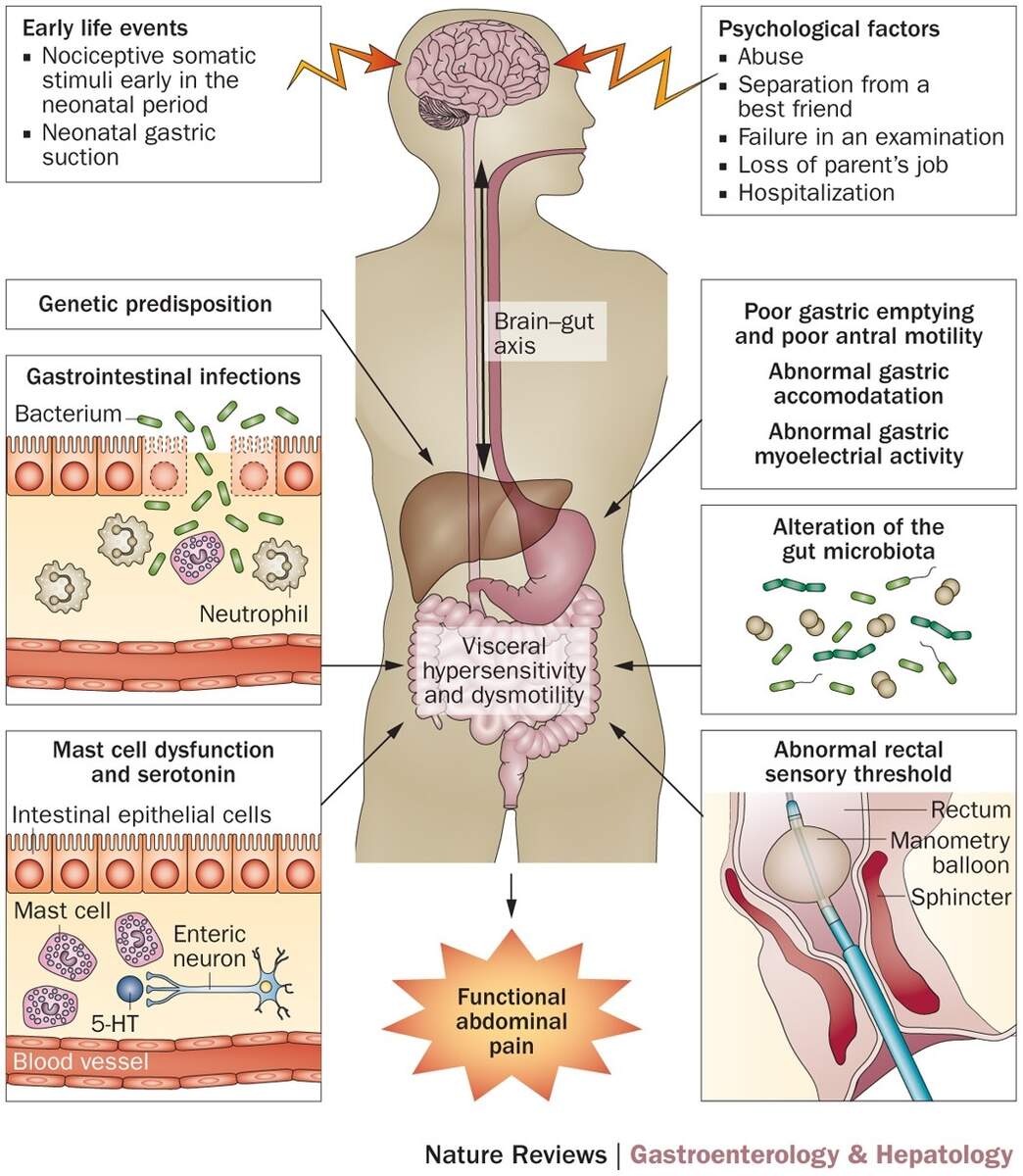 Childhood Functional Abdominal Pain Mechanisms And Management Nature Reviews Gastroenterology Hepatology