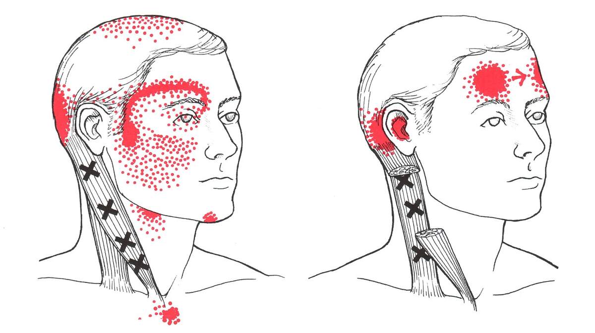 Sternocleidomastoid The Trigger Point Referred Pain Guide