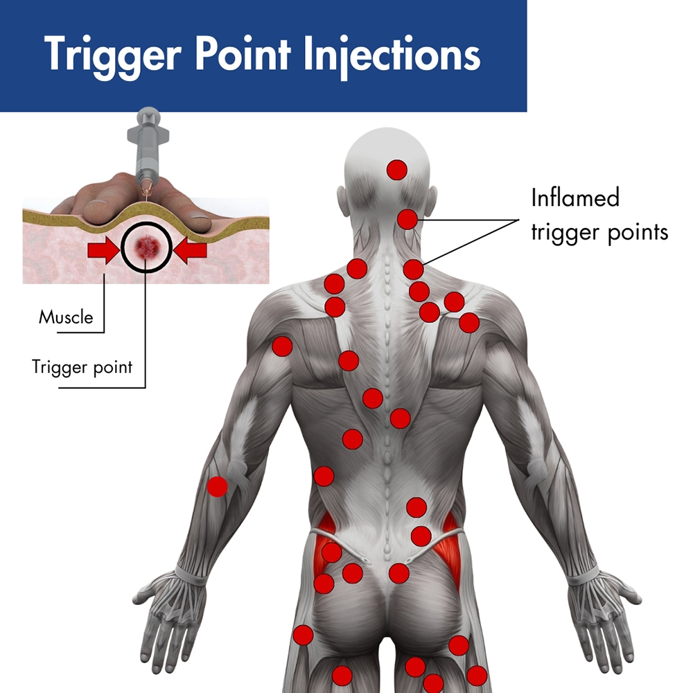 Sternocleidomastoid The Trigger Point Referred Pain Guide